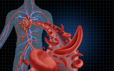 Transfusão na Doença Falciforme