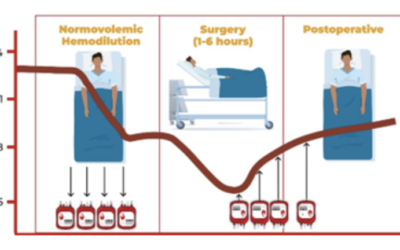 Conheça um pouco mais sobre a hemodiluição normovolêmica aguda