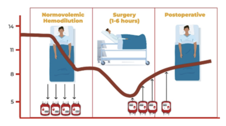 Conheça um pouco mais sobre a hemodiluição normovolêmica aguda